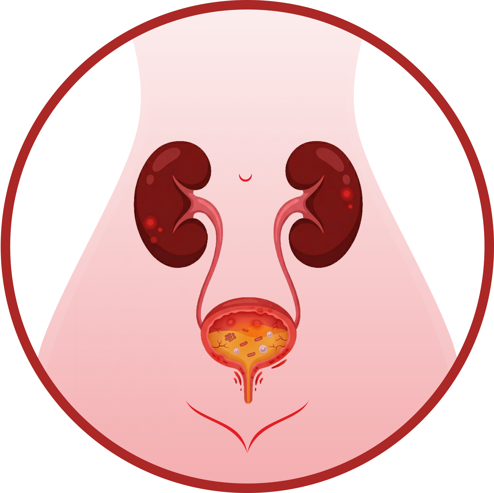 Шаг 1: воспаление мочевого пузыря